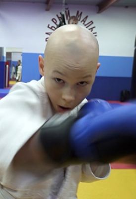 What is ALOPECIA?
