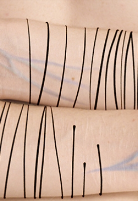 Scars